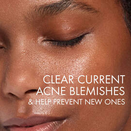 Suitable for adult acne, the Normaderm PhytoAction Daily Deep Cleansing Gel clears current acne blemishes and helps prevent new ones.