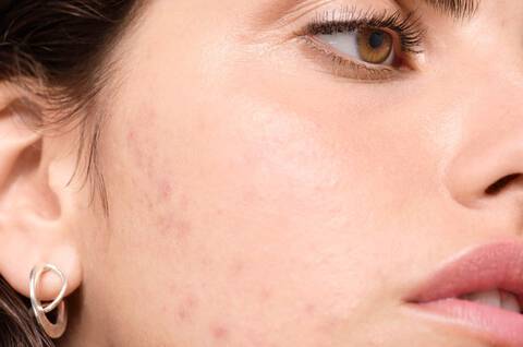 How-to-Treat-and-Prevent-Seasonal-Acne-Hero-Image
