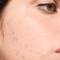 How-to-Treat-and-Prevent-Seasonal-Acne-Hero-Image