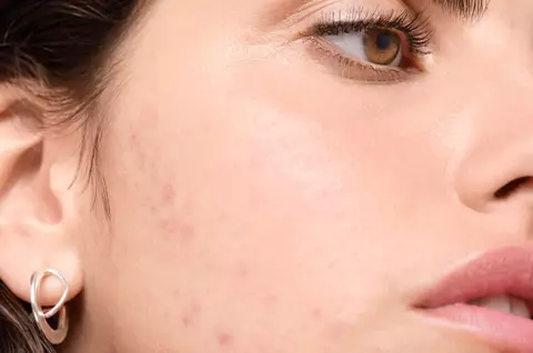 How-to-Treat-and-Prevent-Seasonal-Acne-Hero-Image