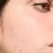 How-to-Treat-and-Prevent-Seasonal-Acne-Hero-Image