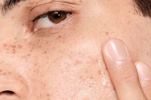 What is Oily Skin & How to Take Care of It