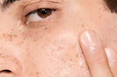 What is Oily Skin & How to Take Care of It