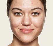 IMPERFECTIONS ON OILY SKIN